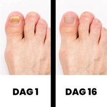 Afbeelding in Gallery-weergave laden, DermaNail - Gepatenteerde nagelschimmeltherapie – voor gezonde nagels binnen 4 weken
