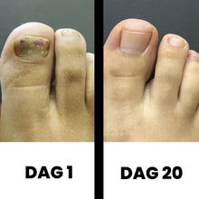 Afbeelding in Gallery-weergave laden, PureNail - Gepatenteerde nagelschimmeltherapie – voor gezonde nagels binnen 4 weken

