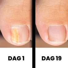 Afbeelding in Gallery-weergave laden, PureNail - Gepatenteerde nagelschimmeltherapie – voor gezonde nagels binnen 4 weken
